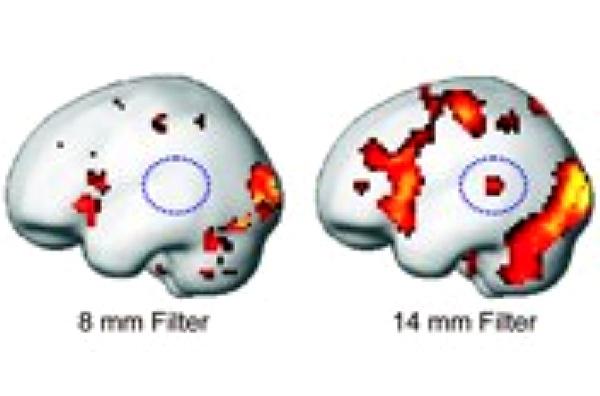 Der Filter macht den Unterschied: In denselben Ausgangsdaten erscheint
eine Gehirnregion (eingekreist) mal aktiv, mal inaktiv – allein abhängig von
der „Siebgröße“ des eingesetzten Datenfilters. (Bild: Universität Freiburg)