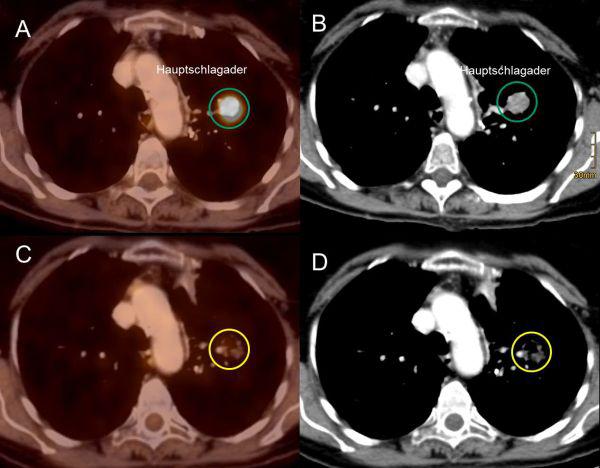Abbildung A und B: Dargestellt ist eine 66j. Patientin mit einem Lungentumor (grüner Kreis), der in der PET/CT (A) leuchtet und
damit aktive Tumorzellen anzeigt. Die Patientin wurde stereotaktisch fraktioniert bestrahlt. Es wurde eine sehr
vorsichtige Dosierung gewählt, so dass trotz der Nähe zur zentralen Hauptschlagader keine Nebenwirkungen
beobachtete wurden. 1.5 Jahre nach der Behandlung findet sich im Bereich des ehemaligen Tumors nur noch
Narbengewebe (gelber Kreis in C und D), das keine Tumoraktivität mehr anzeigt (C). Abbildung A und B: Dargestellt ist eine 66j. Patientin mit einem Lungentumor (grüner Kreis), der in der PET/CT (A) leuchtet und
damit aktive Tumorzellen anzeigt. Die Patientin wurde stereotaktisch fraktioniert bestrahlt. Es wurde eine sehr
vorsichtige Dosierung gewählt, so dass trotz der Nähe zur zentralen Hauptschlagader keine Nebenwirkungen
beobachtete wurden. 1.5 Jahre nach der Behandlung findet sich im Bereich des ehemaligen Tumors nur noch
Narbengewebe (gelber Kreis in C und D), das keine Tumoraktivität mehr anzeigt (C).